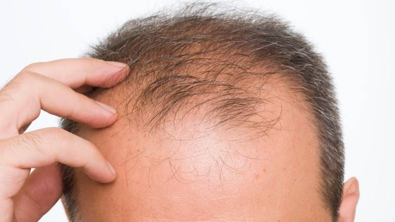 Scientists Discover Breakthrough Solution For Baldness